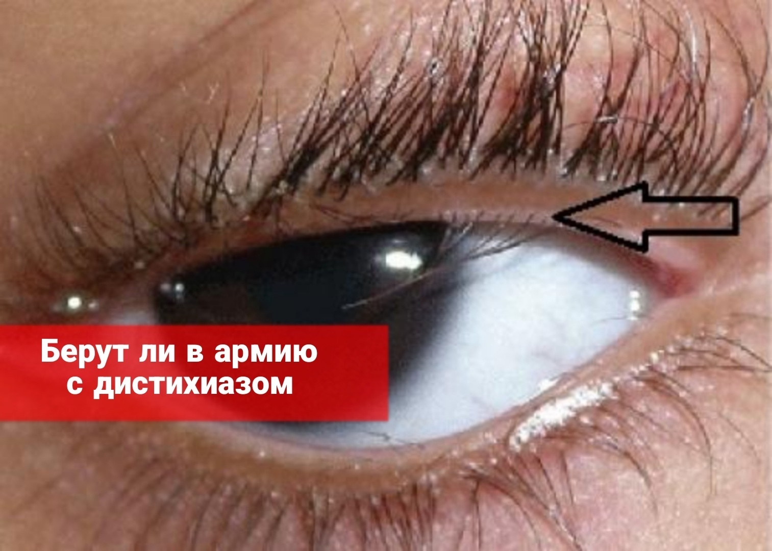 Берут ли в армию с дистихиазом