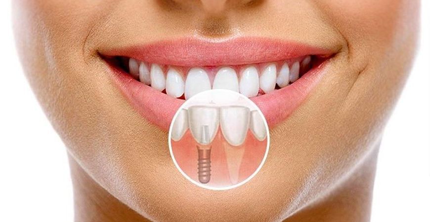 Имплантация зубов: плюсы и минусы
