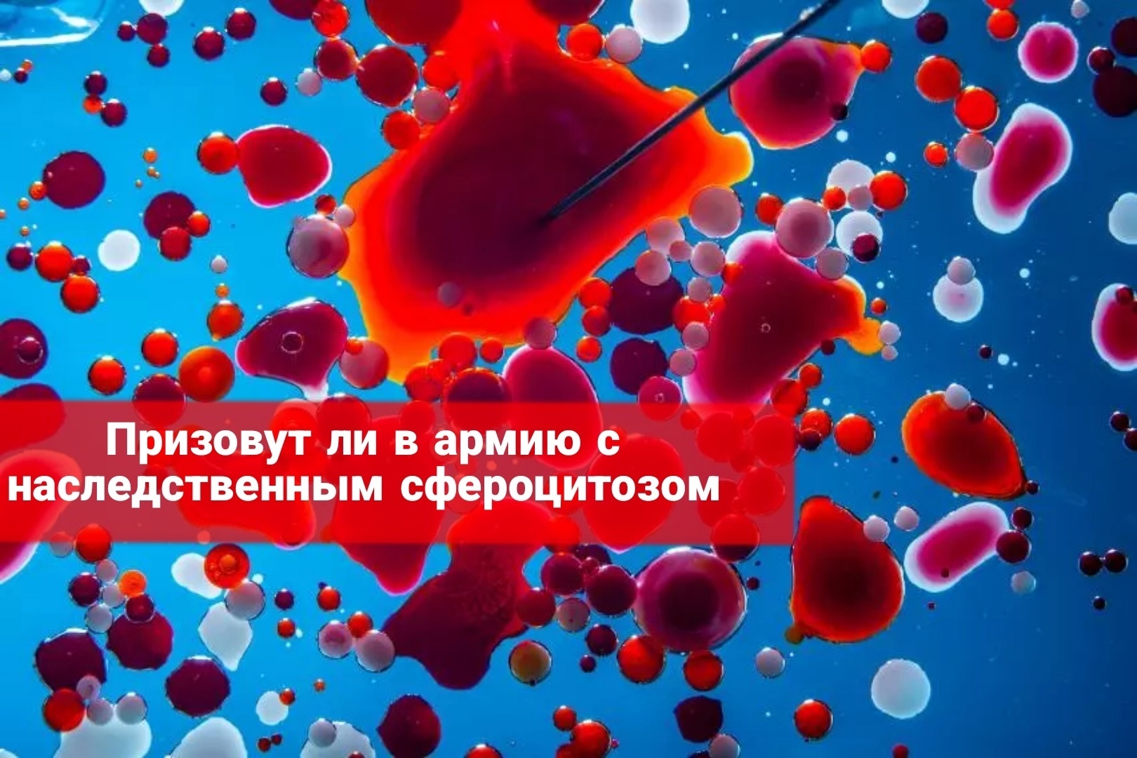 Призовут ли в армию с наследственным сфероцитозом
