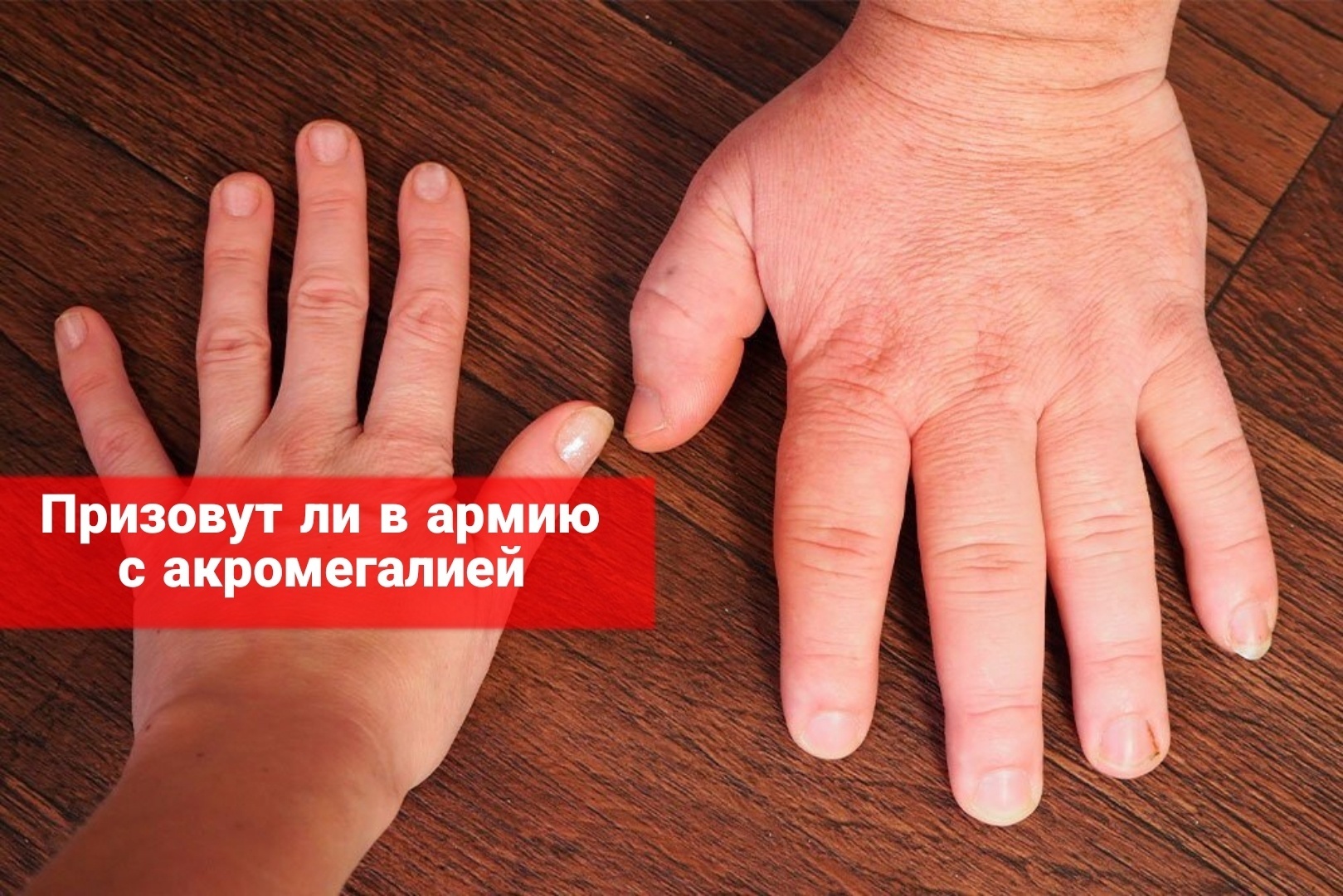 Призовут ли в армию с акромегалией