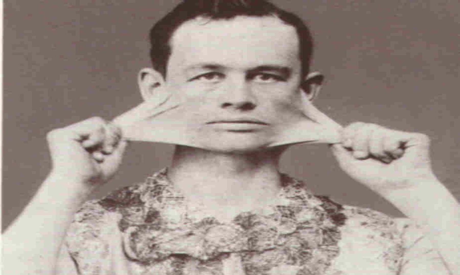 10 страшных болезней, которые безжалостно уродуют людей.