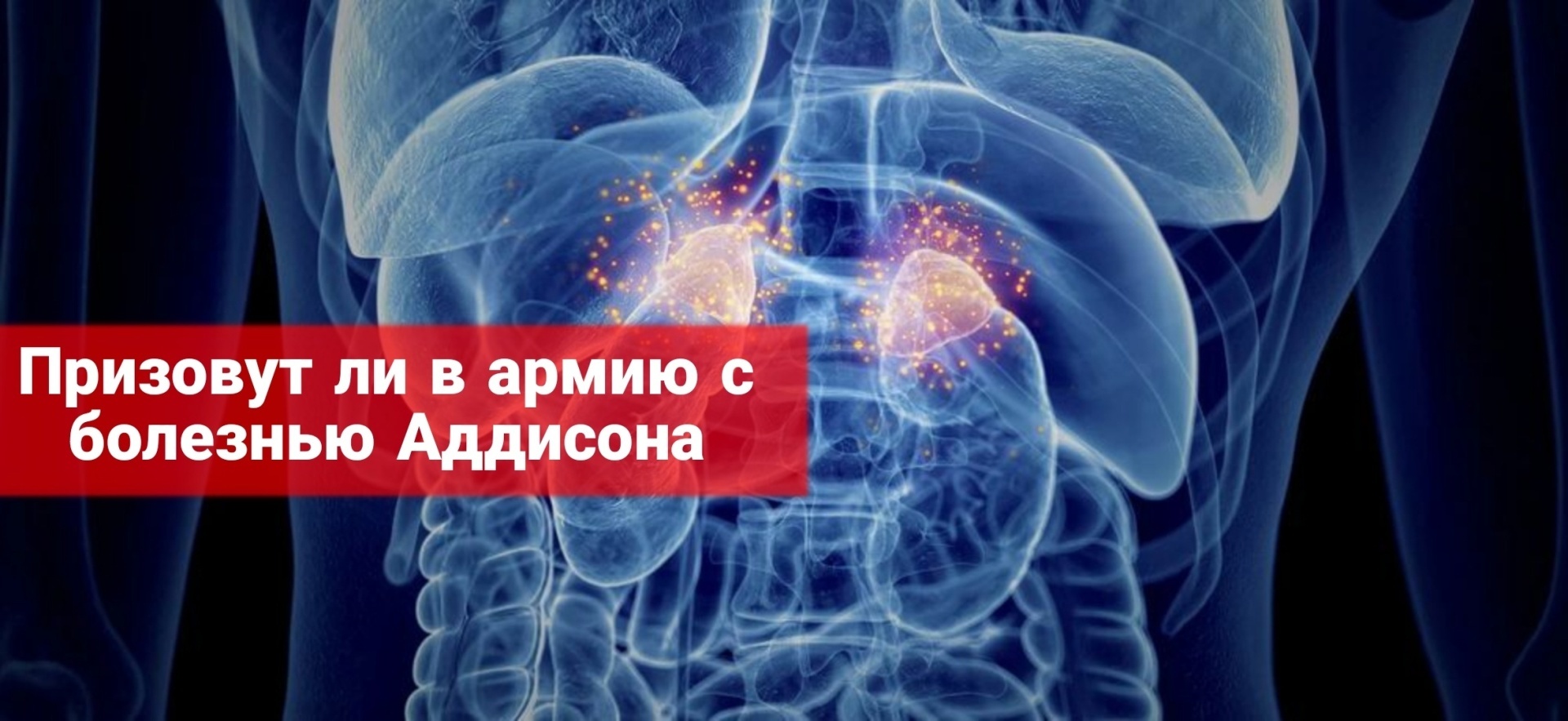 Призовут ли в армию с болезнью Аддисона