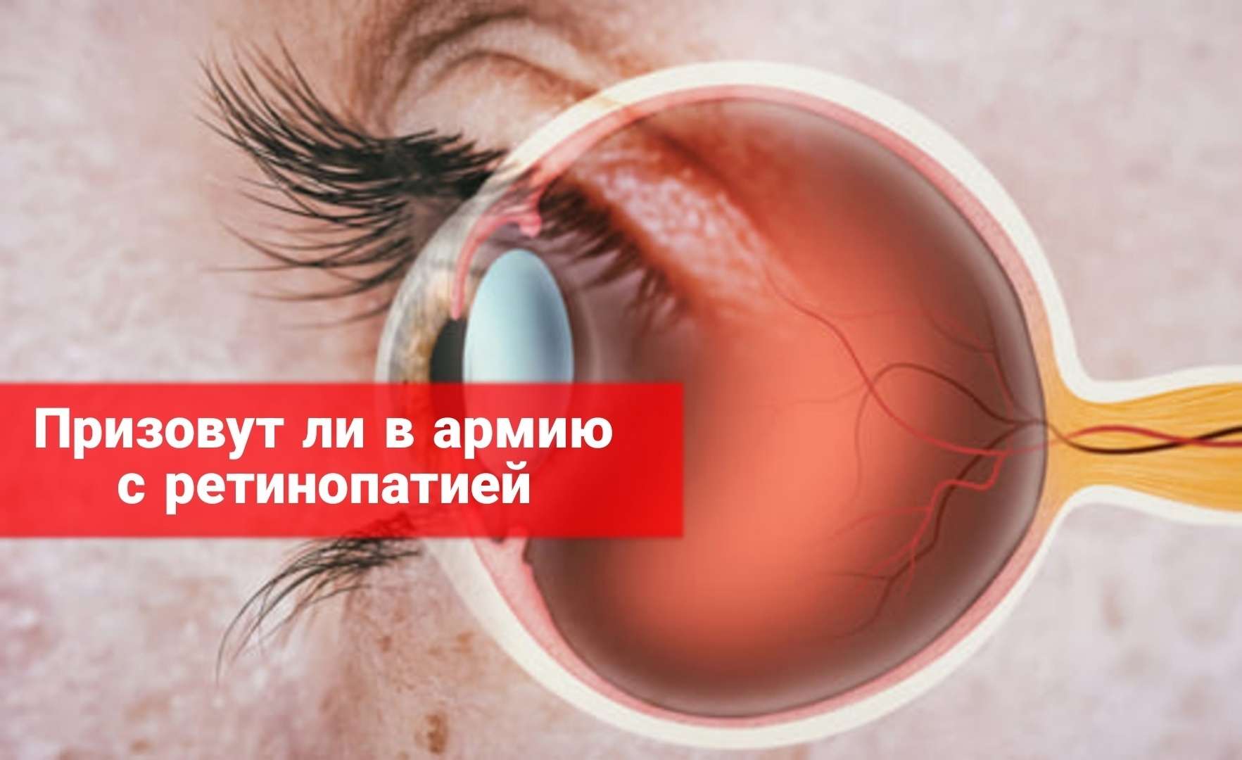 Призовут ли в армию с ретинопатией