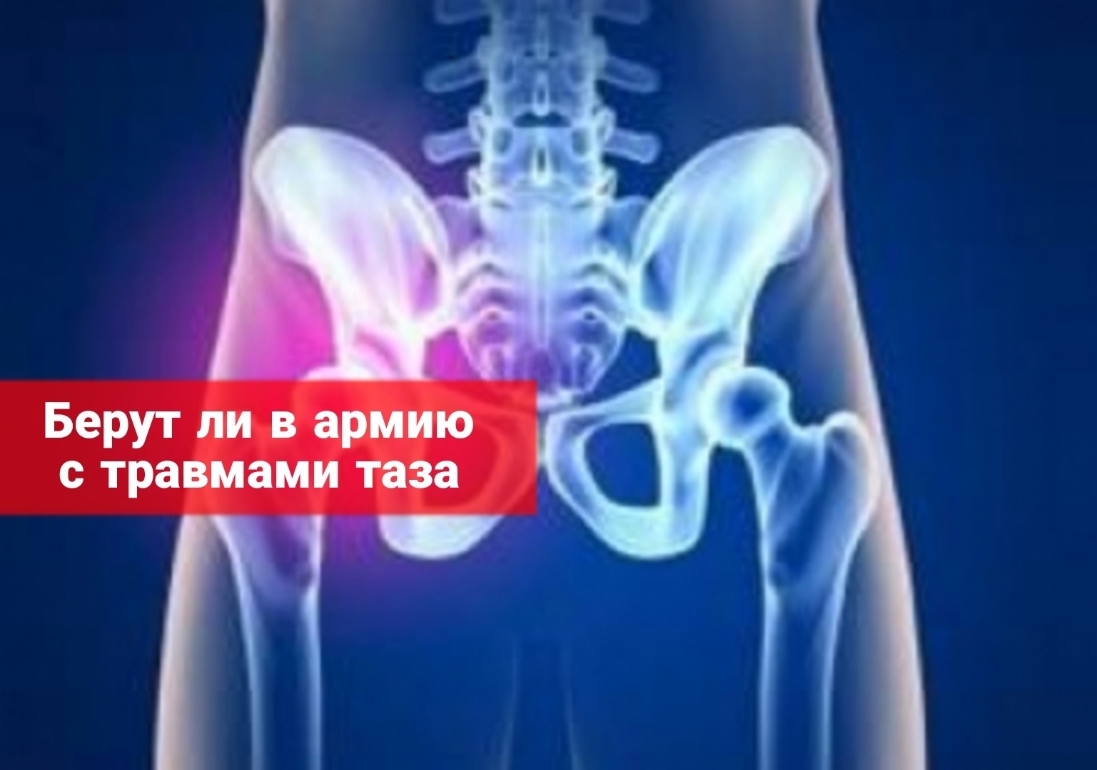 Берут ли в армию с травмами таза