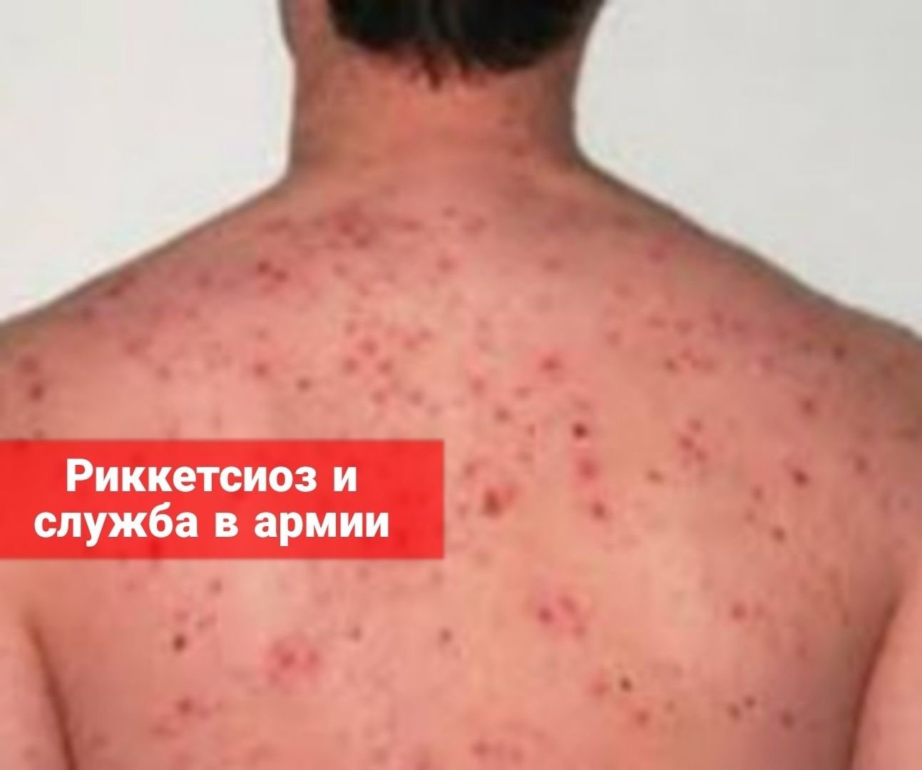 Риккетсиоз и служба в армии