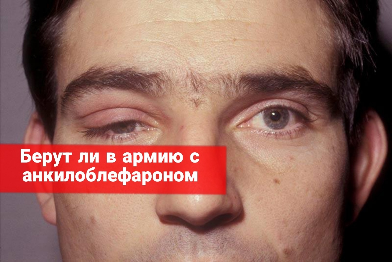 Берут ли в армию с анкилоблефароном