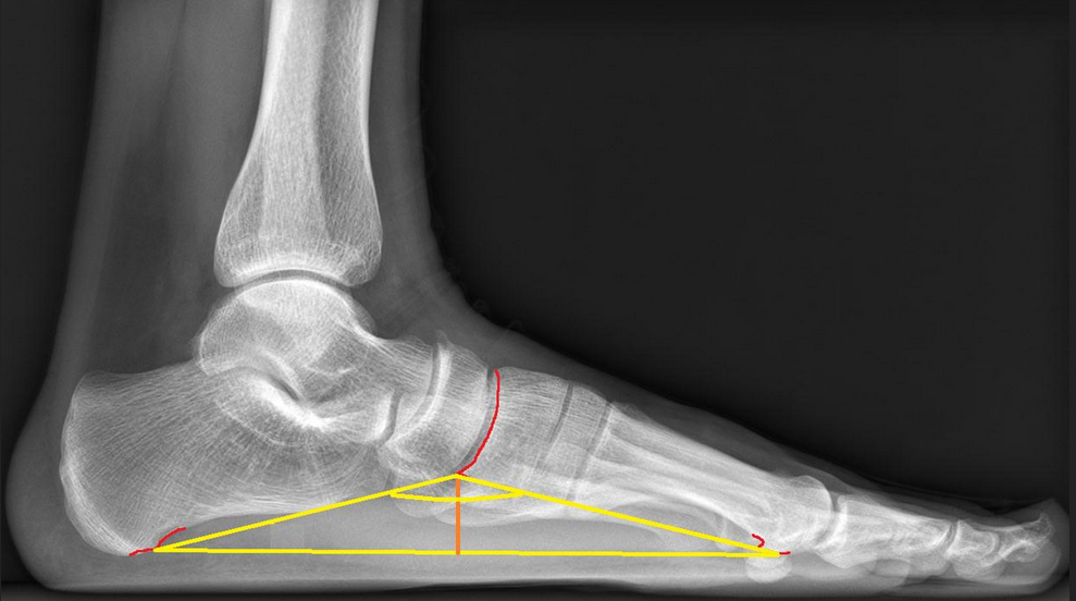 Опять про плоскостопие и опять про доказывание в военкомате