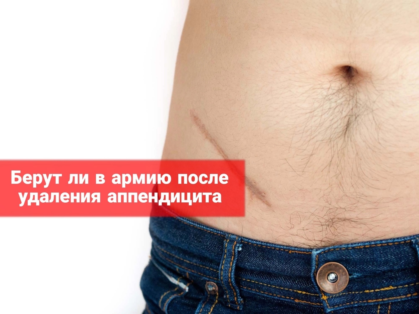 Берут ли в армию после удаления аппендицита