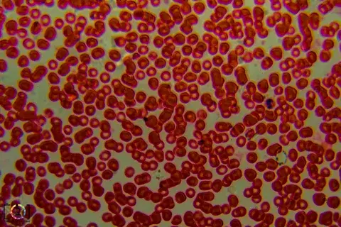 О чем говорит результат анализа крови.