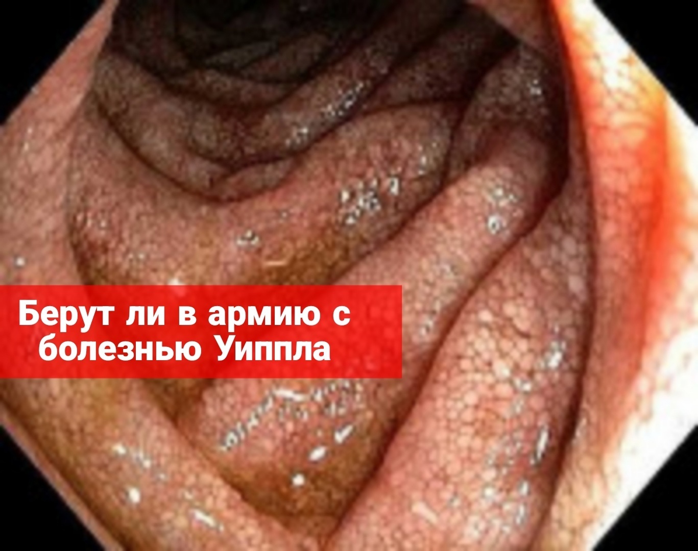 Берут ли в армию с болезнью Уиппла?