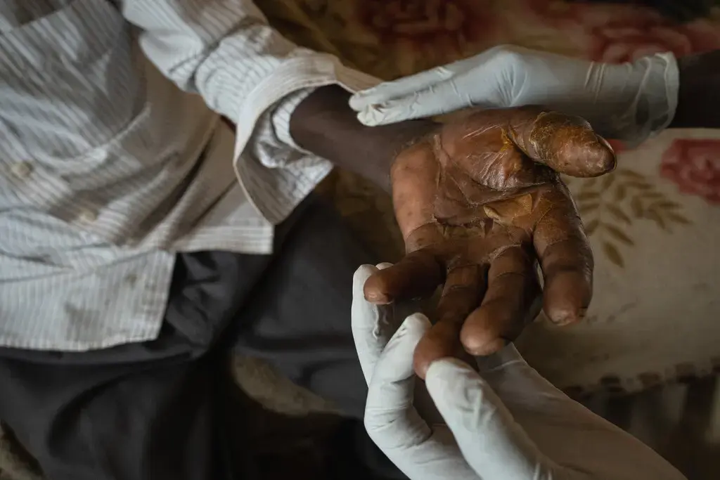 Тайна вспышки сибирской язвы в Африке...