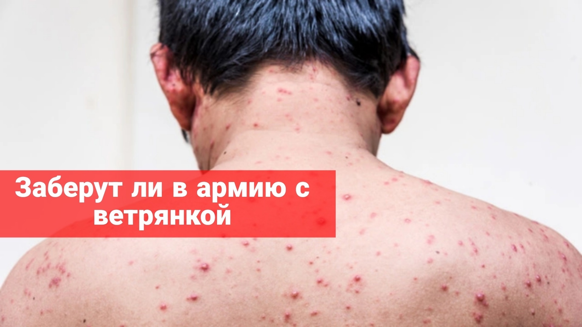 Заберут ли в армию с ветрянкой?