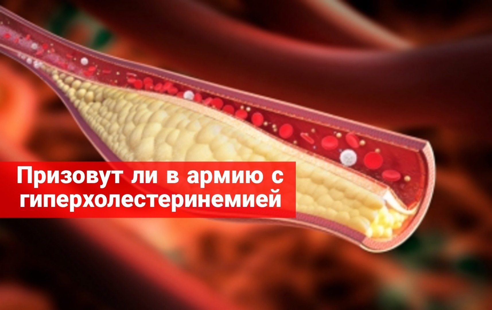 Призовут ли в армию с гиперхолестеринемией
