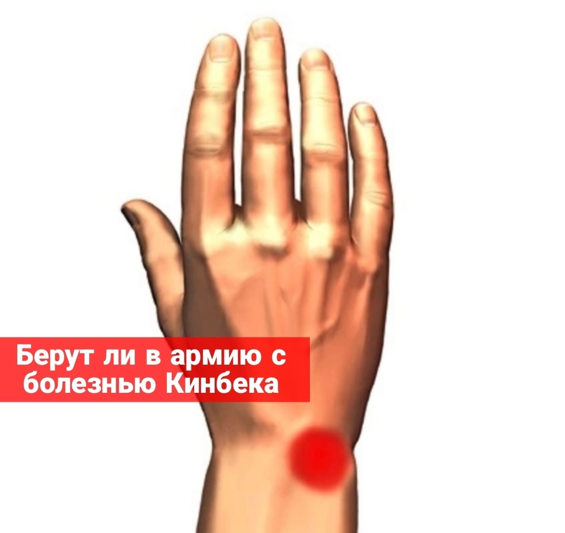 Берут ли в армию с болезнью Кинбека