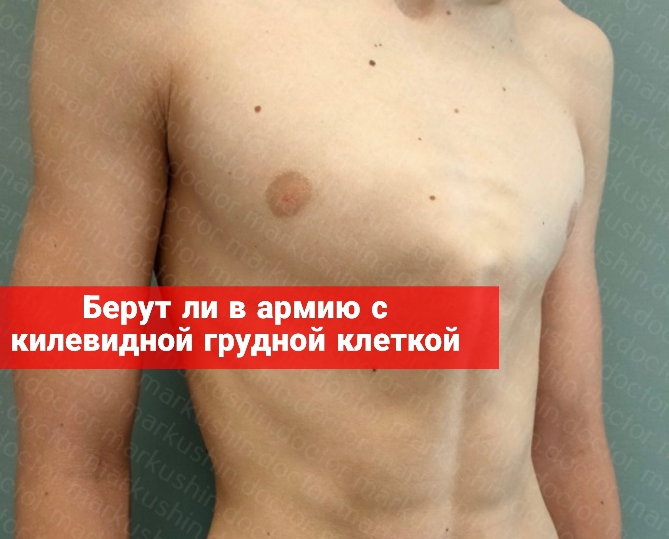 Берут ли в армию с килевидной грудной клеткой
