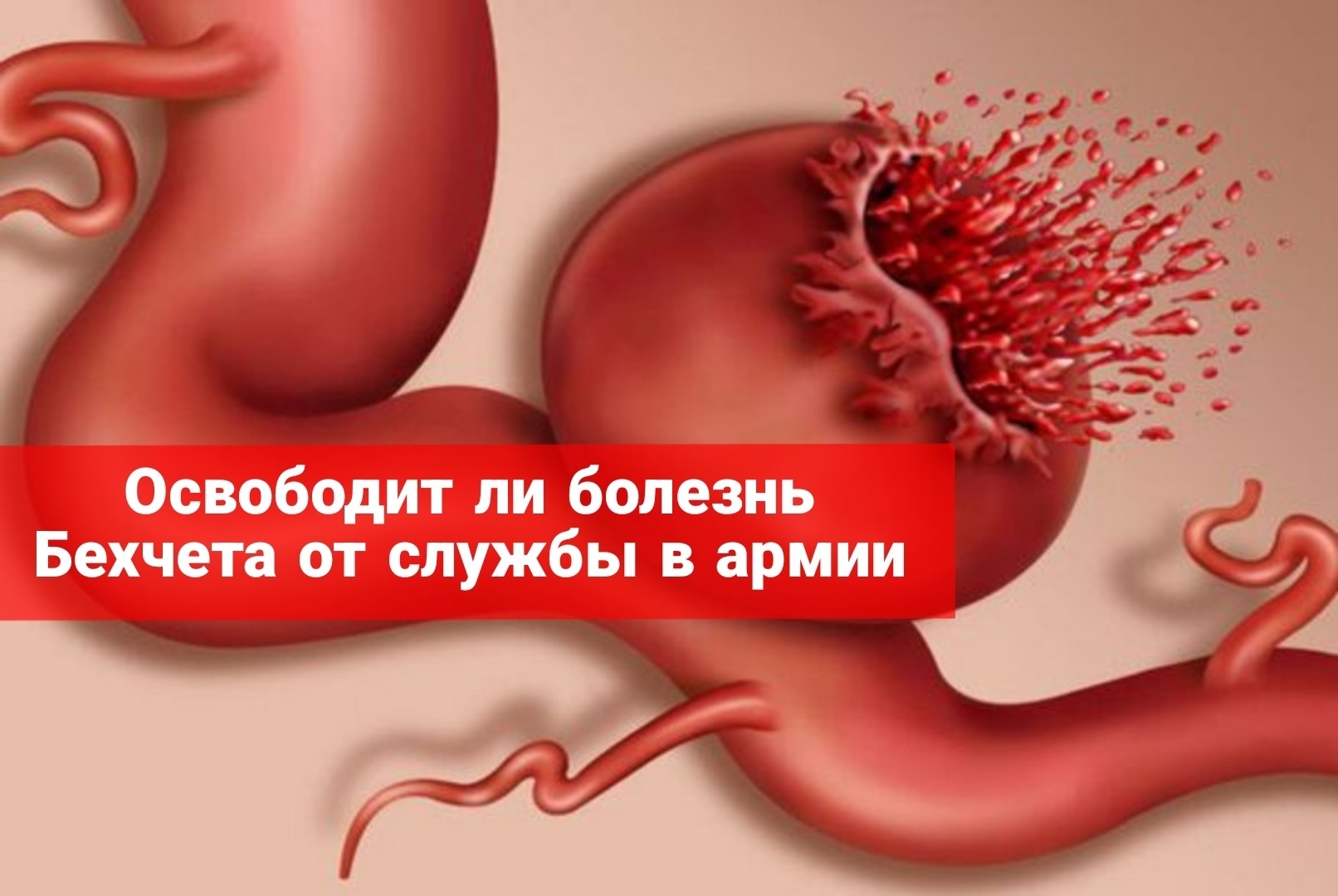 Освободит ли болезнь Бехчета от службы в армии