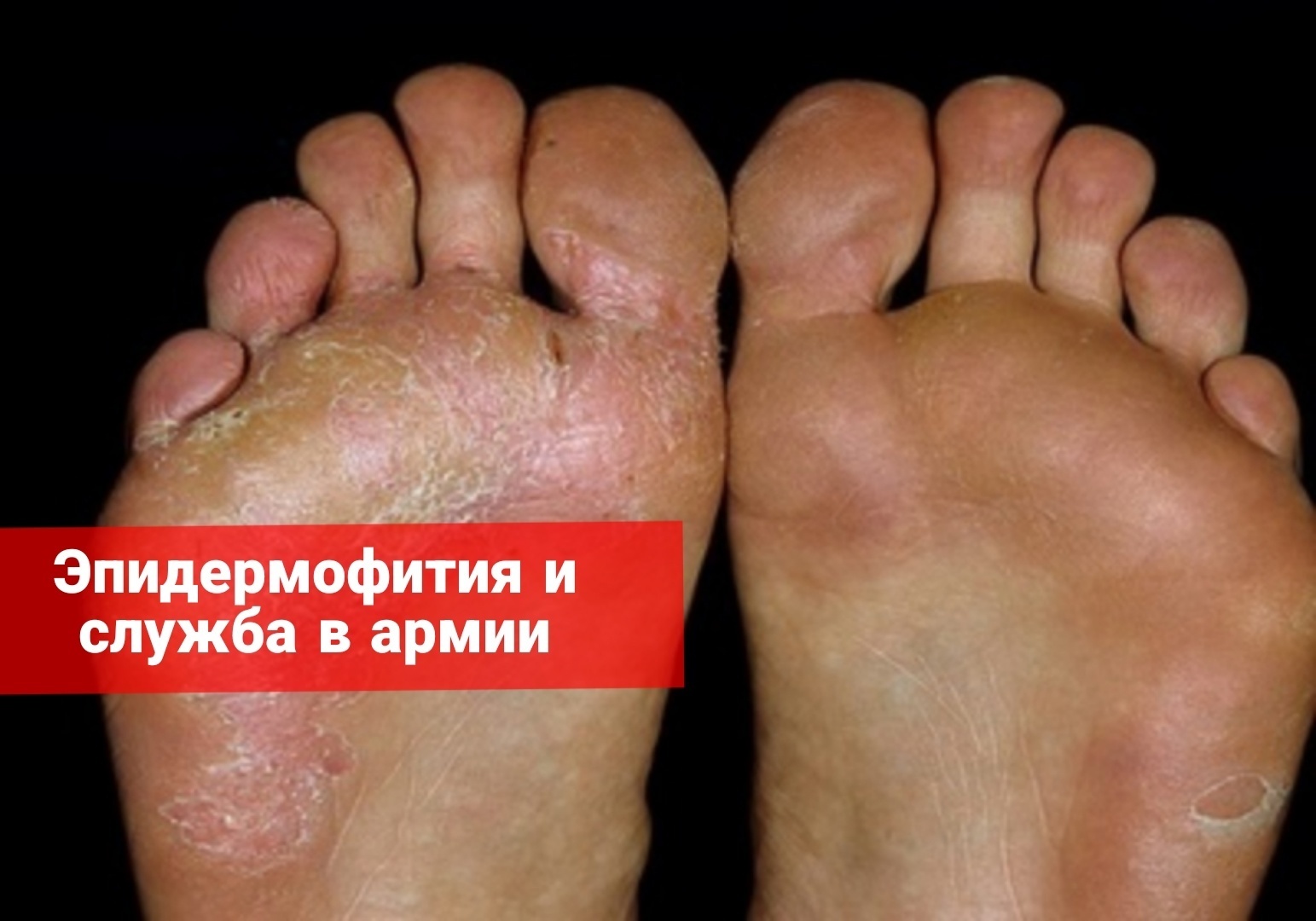 Эпидермофития и служба в армии