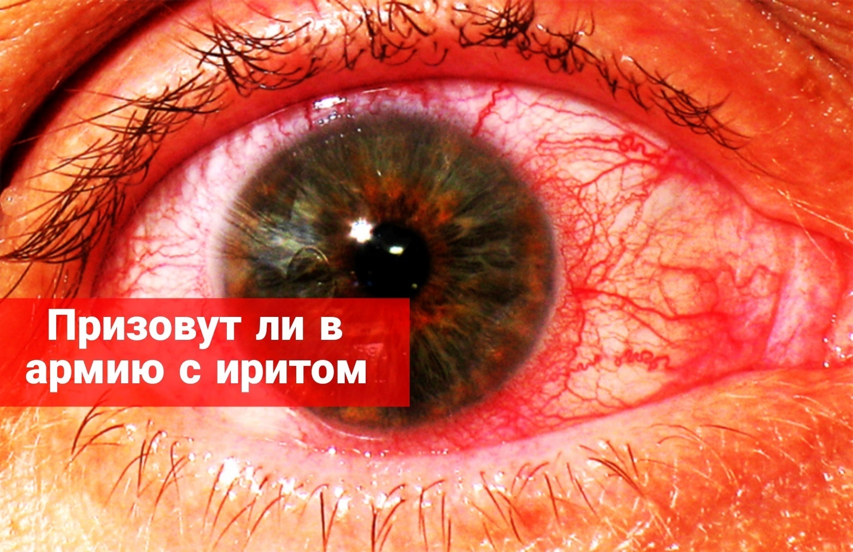 Призовут ли в армию с иритом