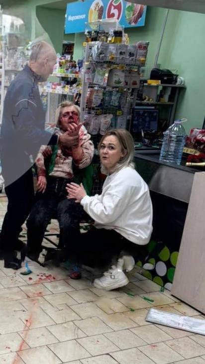 В Самаре напали на владельца магазина, откусили нос в результате жестокого инцидента