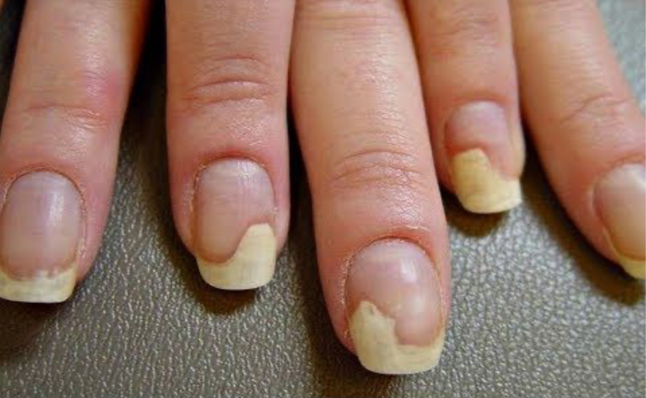 Чем опасно «перенашивать» ногти с гель лаком?