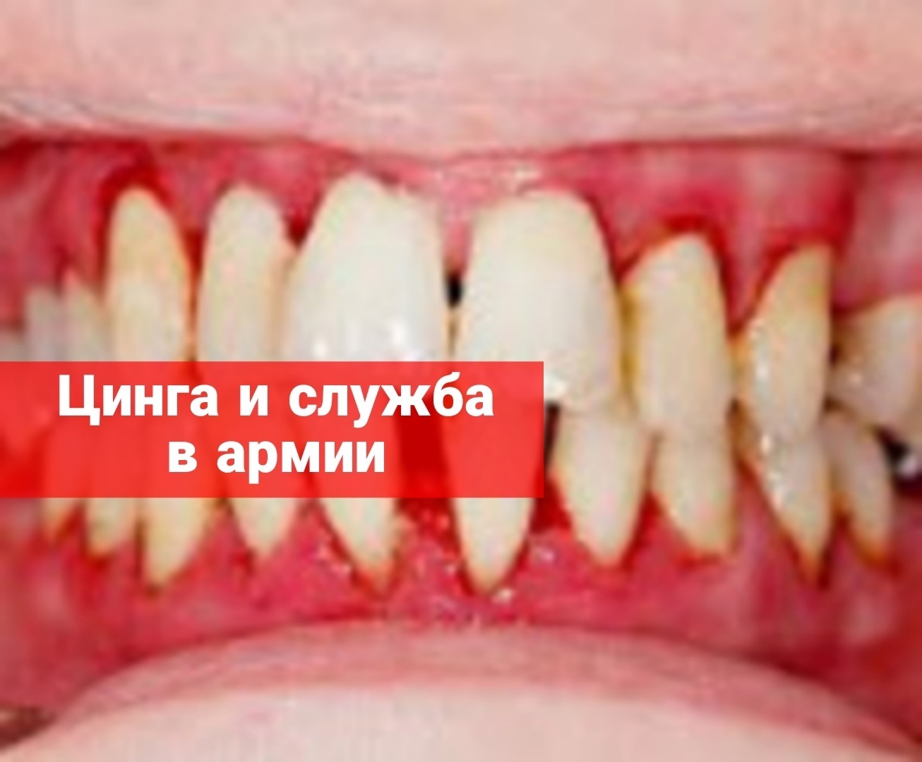 Цинга и служба в армии
