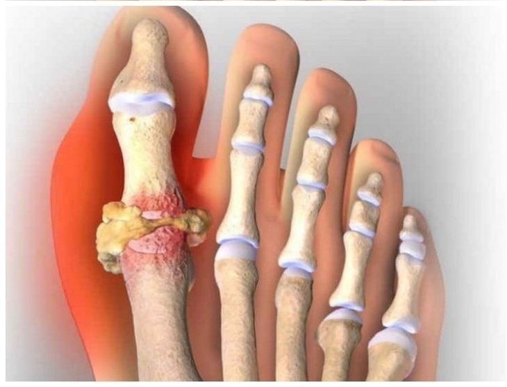 Вальгофлекс Подагра: Выбрось костыли и скажи 'нет' операциям! Как это средство взорвало рынок?"
