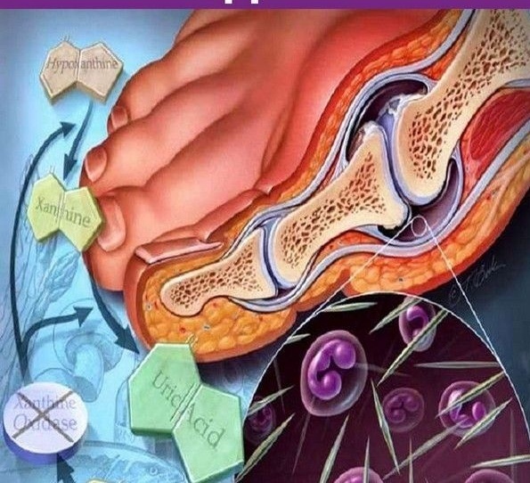Вальгофлекс Подагра: Выбрось костыли и скажи 'нет' операциям! Как это средство взорвало рынок?"