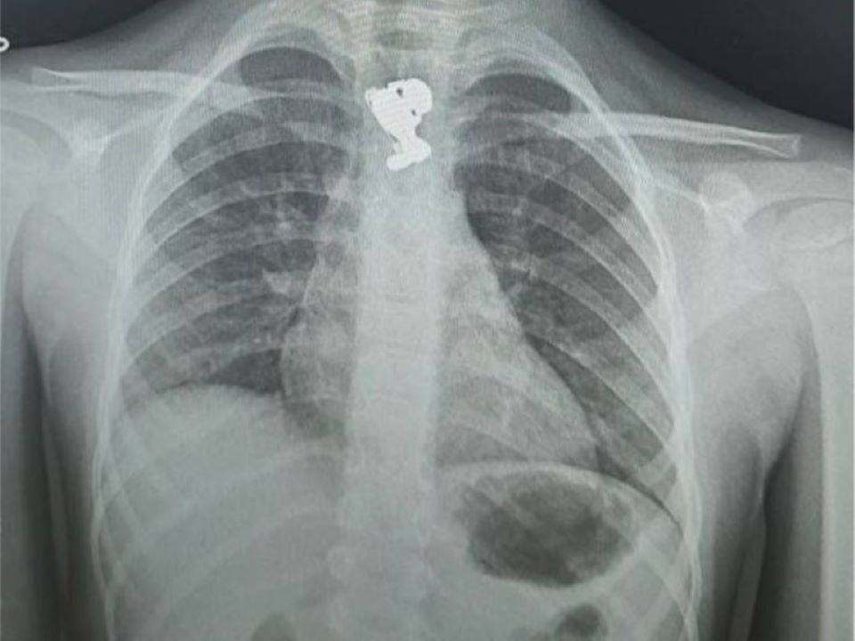 Маминого зайчика проглотила пятилетняя девочка, а взрослый парень - очки, зубную щетку и дверную ручку