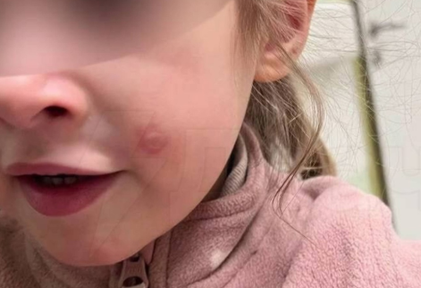 Инцидент в Зеленограде: женщина потушила сигарету об лицо трехлетней девочки