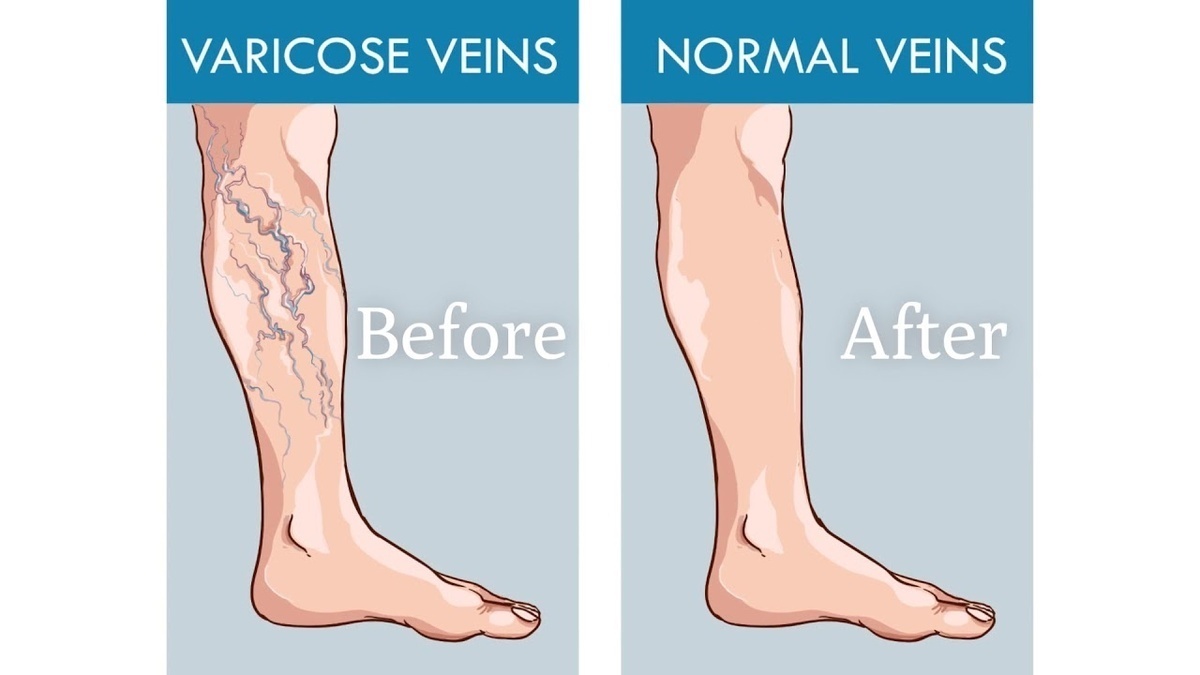 Варикоз: как избавиться от боли и вернуть здоровье ног без операций и дорогих процедур