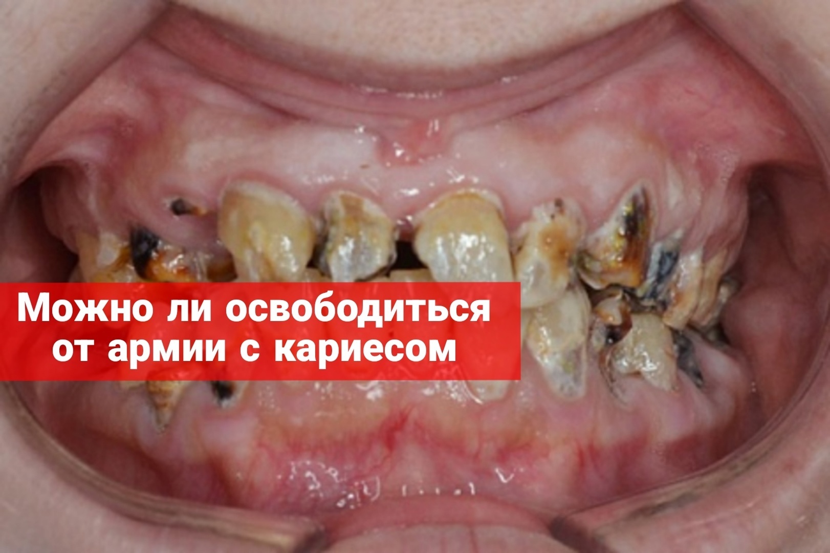 Можно ли освободиться от армии с кариесом