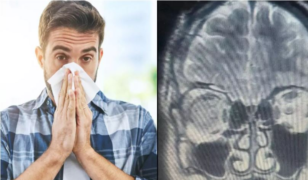 Насморк или утечка мозговой жидкости