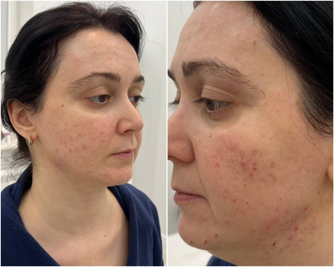 Как кожа помнит всё. Рассказ врача о лечении рубцов