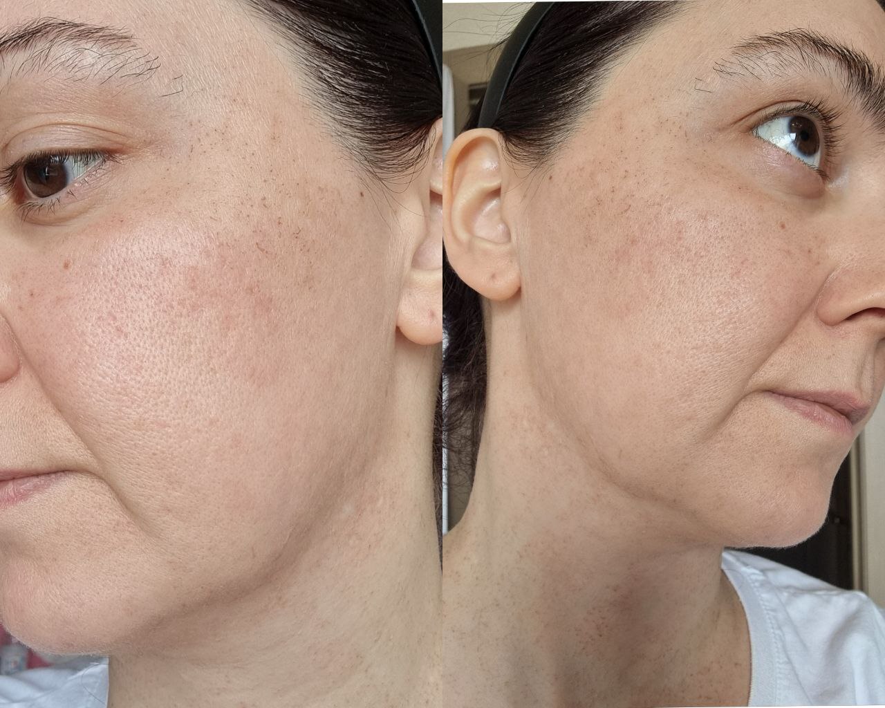 Как кожа помнит всё. Рассказ врача о лечении рубцов