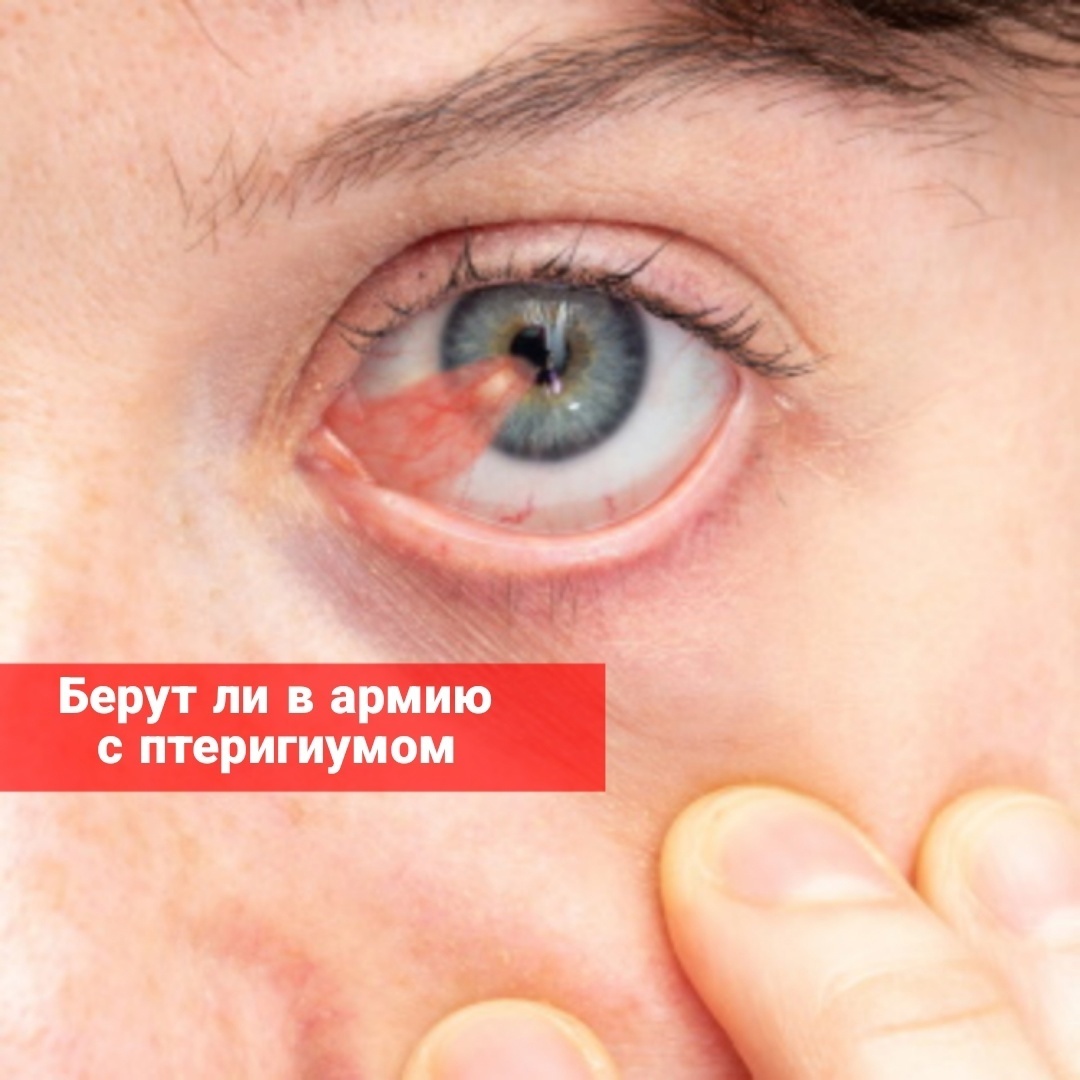Берут ли в армию с птеригиумом