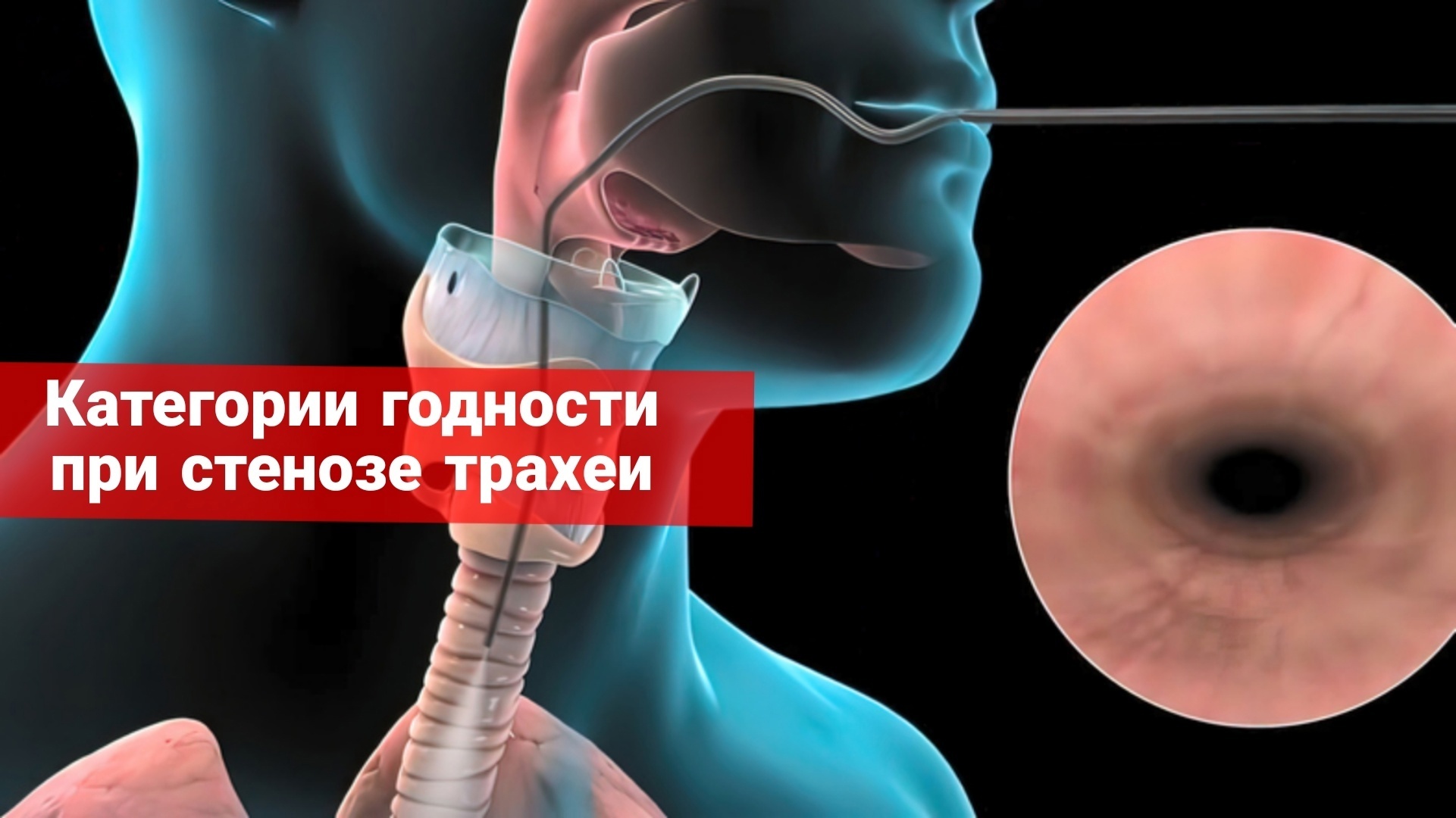 Категории годности при стенозе трахеи