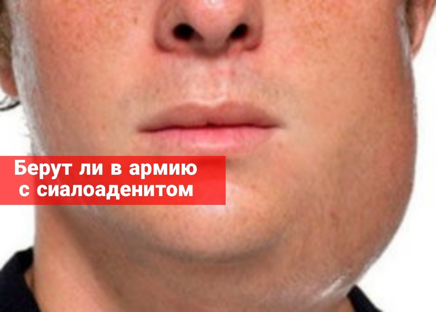 Берут ли в армию с сиалоаденитом