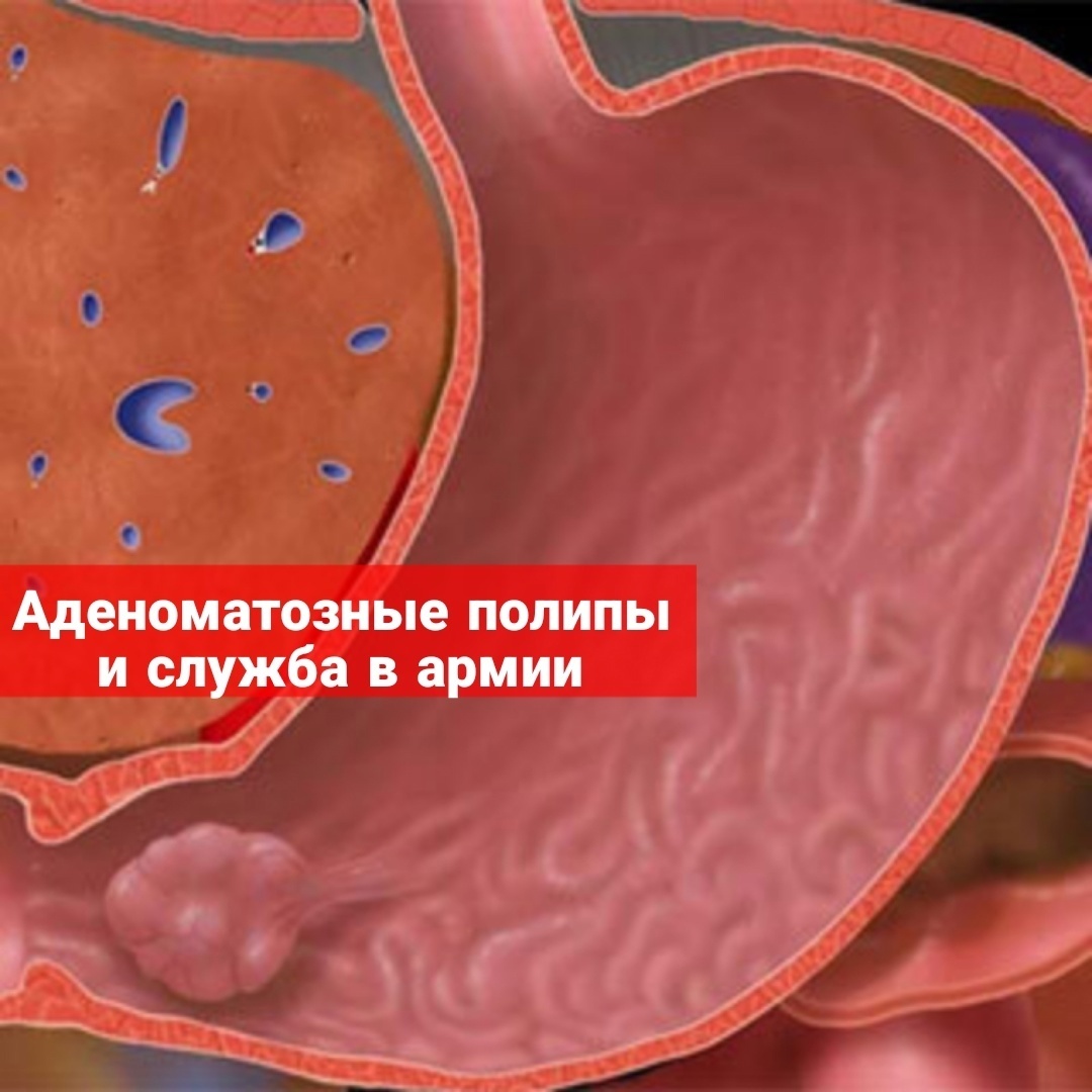 Аденоматозные полипы и служба в армии