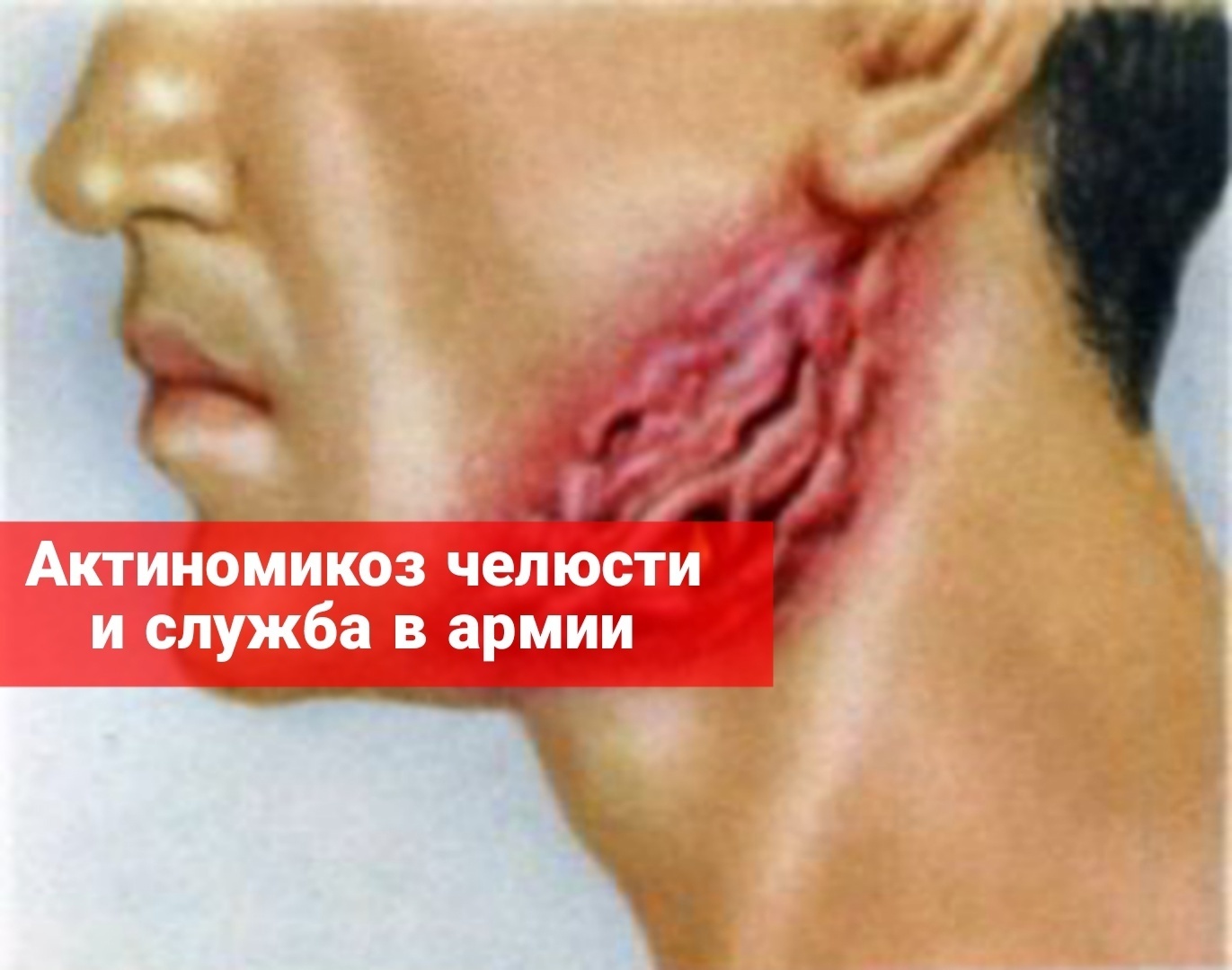 Актиномикоз челюсти и служба в армии