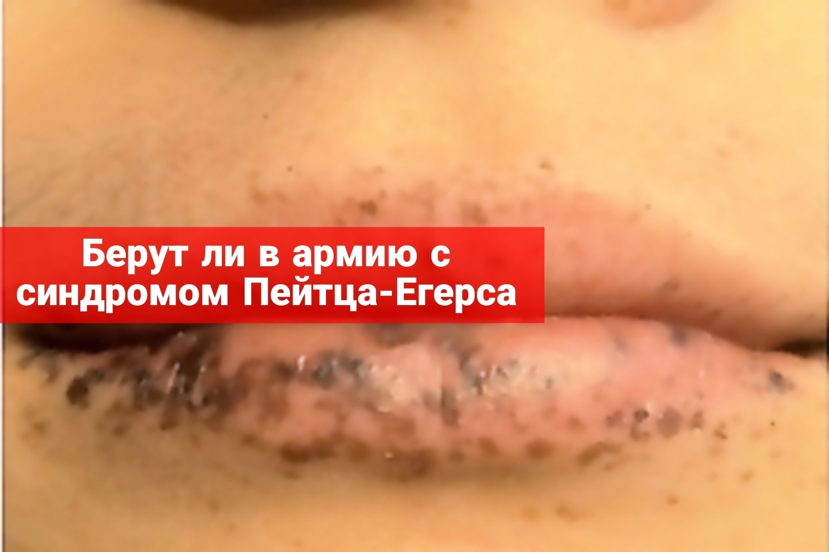 Берут ли в армию с синдромом Пейтца-Егерса