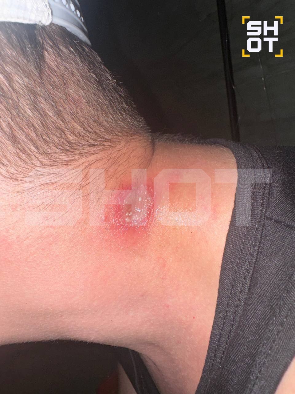 На российских туристов во Вьетнаме и Индонезии нападают летающие ядовитые жуки, оставляя на их коже ожоги и язвы