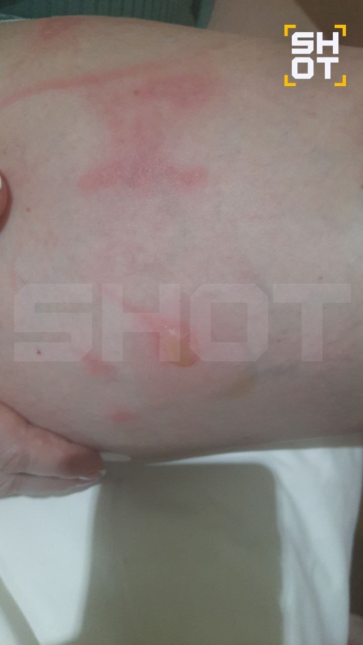 На российских туристов во Вьетнаме и Индонезии нападают летающие ядовитые жуки, оставляя на их коже ожоги и язвы