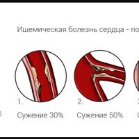 ИБС.JPG