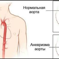 Аневризма.JPG
