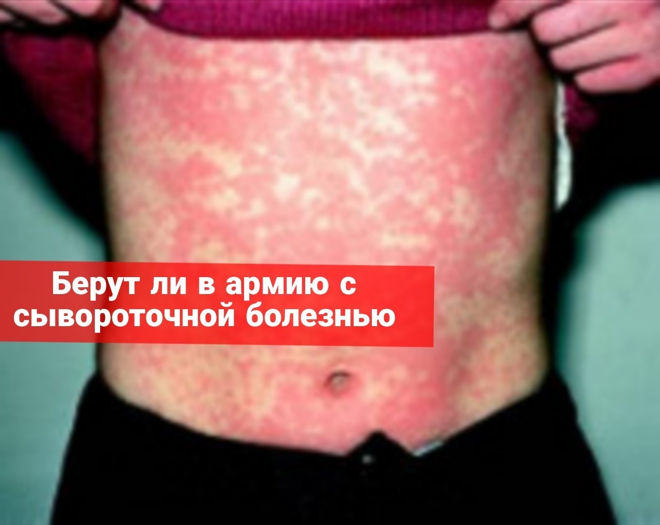 Берут ли в армию с сывороточной болезнью?