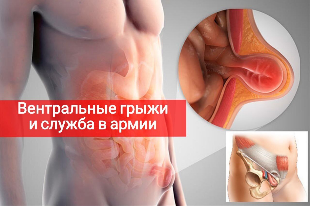 Вентральные грыжи и служба в армии