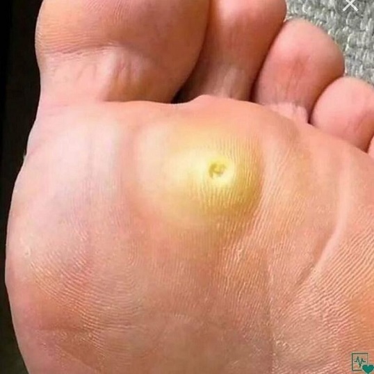 🟩Натоптыши. Лечим натоптыши народными средствами. Дёшево и надежно. Личный опыт