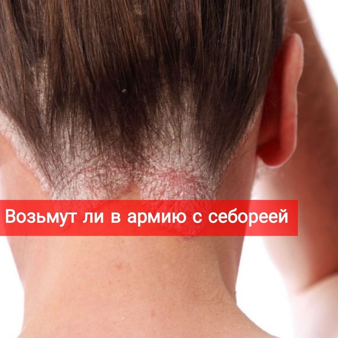 Берут ли в армию с себореей?