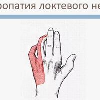 Невропатия локтевого нерва.JPG