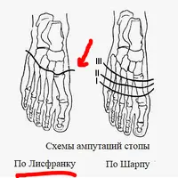 Лисфранк.PNG